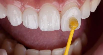 Porcelain Veneers