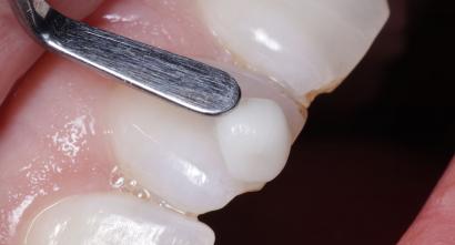 Composite Bonding